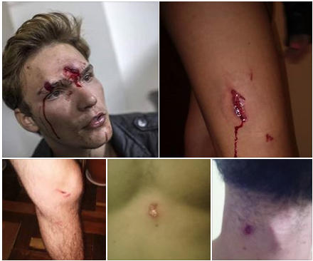 Ferimentos dos adolescentes agredidos na manifestação em Curitiba. Foto: Facebook Felipe Perez