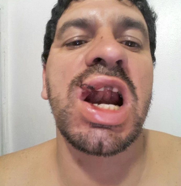 Jean Eduardo registrou os dentes e prótese quebrados