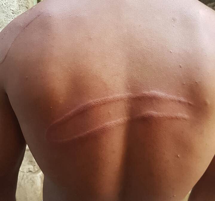 Marcas nas costas de um dos jovens espancados por policiais. Foto: Arquivo pessoal. 
