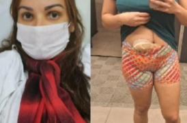 A assistente jurídica Rose Soares da Silva usou bolsa de colostomia por sete meses após tiro de PM | Foto: Arquivo pessoal