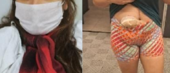 A assistente jurídica Rose Soares da Silva usou bolsa de colostomia por sete meses após tiro de PM | Foto: Arquivo pessoal